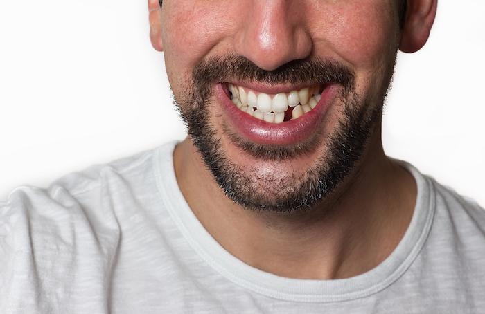 Falta uno o más dientes: complicaciones y opciones de tratamiento