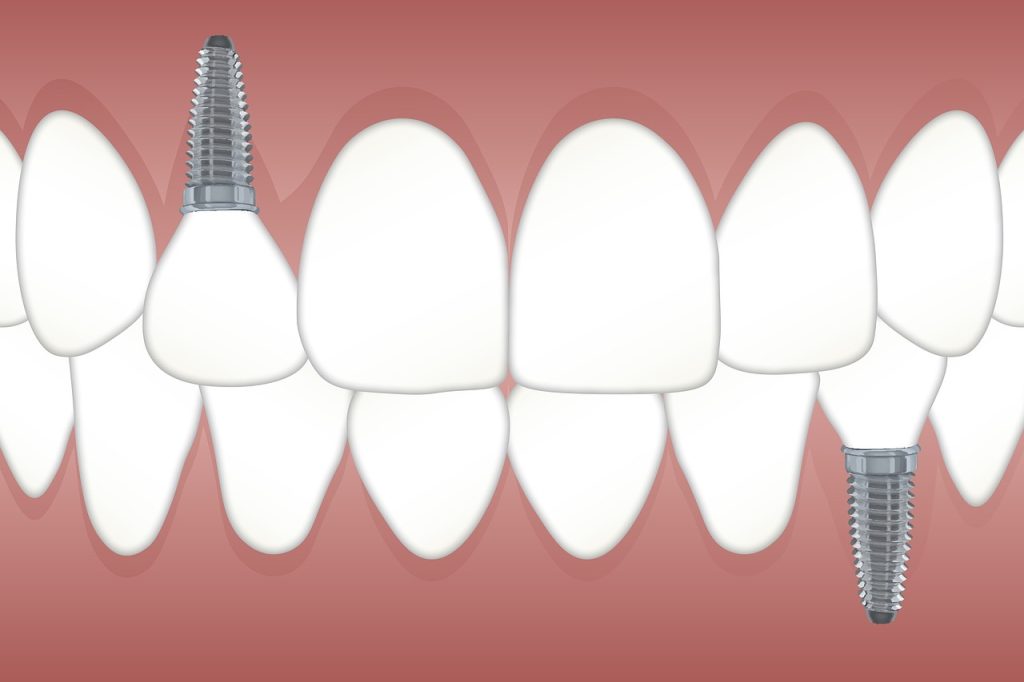 teeth, implant, orthodontics